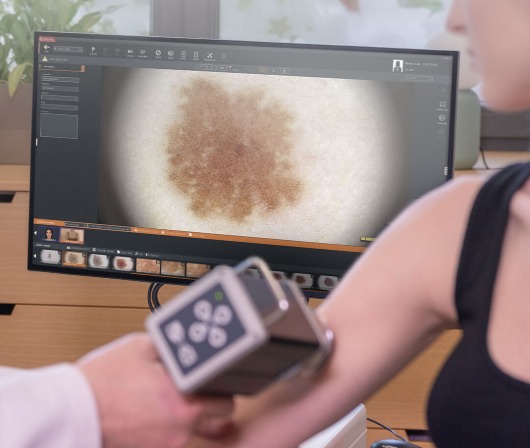 FotoFinder medicam1000